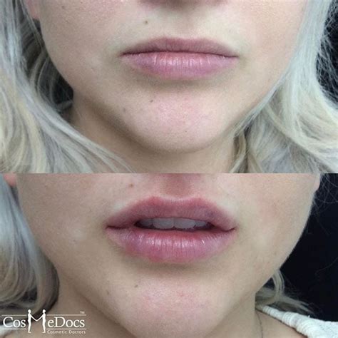 05ml And 1ml Lip Fillers Injections Lip Fillers Before And After