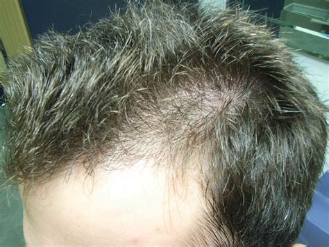 The Hair Loss Centre Male Hair Lossbefore