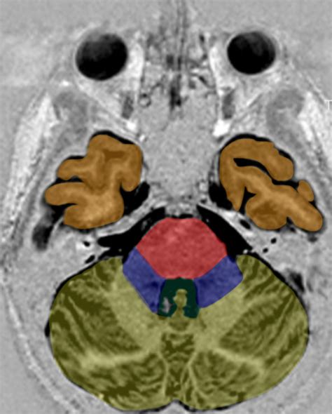 Pons MRI (axial) Diagram | Quizlet