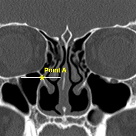 A Axial CT Scan Showing A Type 1 Left Prelacrimal Recess Measuring