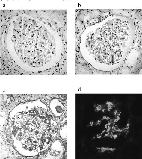 Figure 1 From Development Of Iga Nephropathy 14 Years After Diagnosis Of Membranous Nephropathy