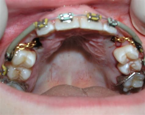 Dental Implant For Impacted Canine At Dot Young Blog