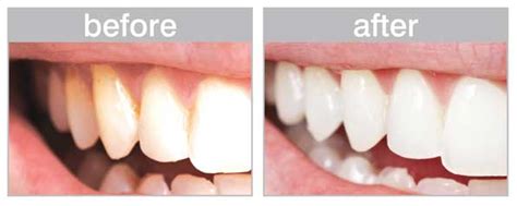 The Difference Between A Deep Teeth Cleaning And A Regular Month