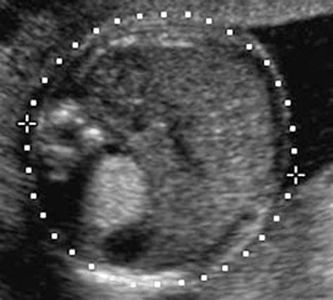 Intraabdominal Fetal Echogenic Masses A Practical Guide To Diagnosis