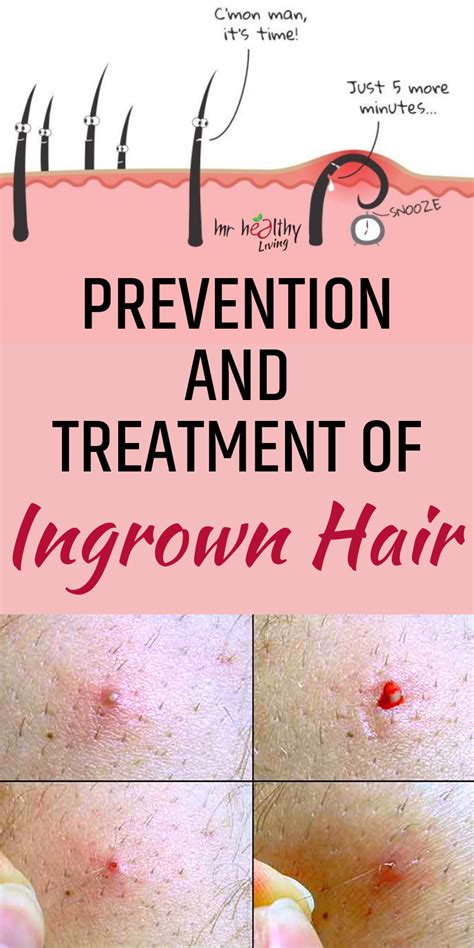 Ingrownhaironbuttocks Ingrown Hair Removal Ingrown Hair Treatment Ingrown Hair