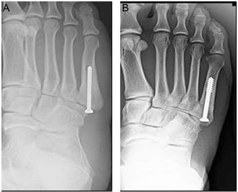 Fifth Metatarsal Jones Fractures In The Athlete David A Porter 2018