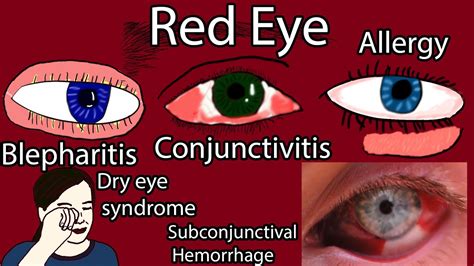 Red Eye Causes Symptoms And Treatment Pink Eye Causes Youtube