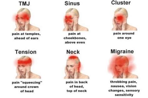Gdje Vas Boli Mjesto Otkriva Tip Glavobolje Uzrok I Rje Enje Koch