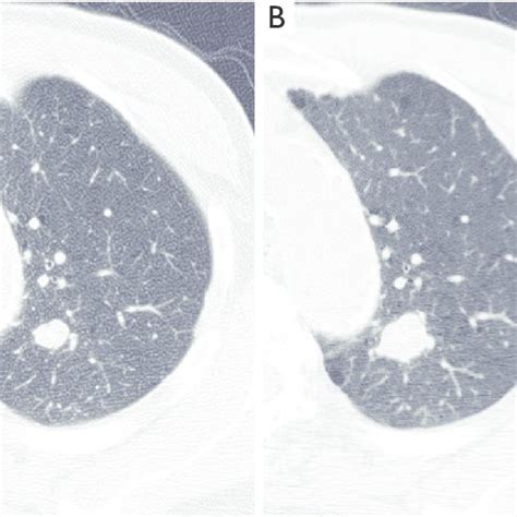 Chest Computed Tomography Findings A Chest Computed Tomography Shows Download Scientific