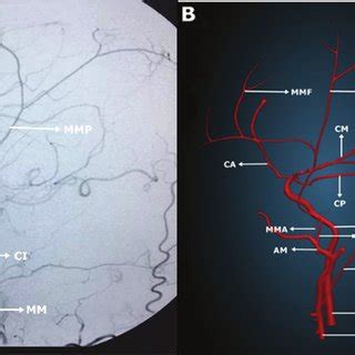 (PDF) Anatomy of the Middle Meningeal Artery