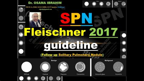 Lung Nodule Fleischner Criteria