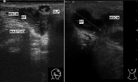 Role Of Ultrasonography In The Detection Of A Subperiosteal Abscess