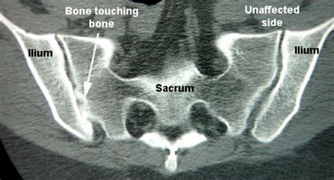 SI Joint Arthritis - Drwolgin