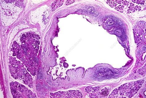 Inflamed Salivary Gland Light Micrograph Stock Image C0035329