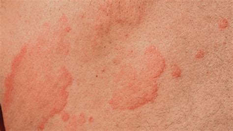 Itchy Rash On Stomach Belly Button Rash Treatment Images