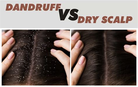 Dandruff Vs Dry Scalp Crucial Things You Must Know