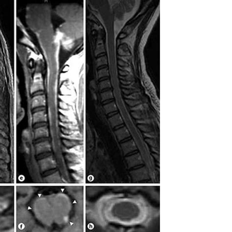 Sagittal Cervical And Thoracic Spine Magnetic Resonance Imaging Mri