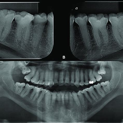 Radiographic Examination A B Periapical Radiographic Showing The