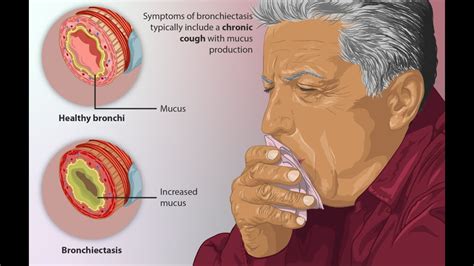 Bronchiectasis Definition Causes Signs And Symptoms Investigation