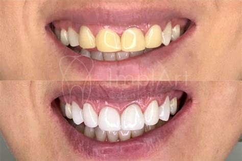 Lentes De Contato Dental Antes E Depois Kb Implart