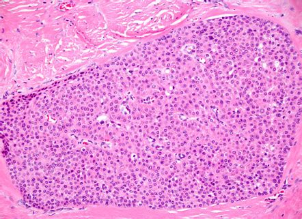 Clear cell hidradenoma (nodular hidradenoma) | Image | Radiopaedia.org