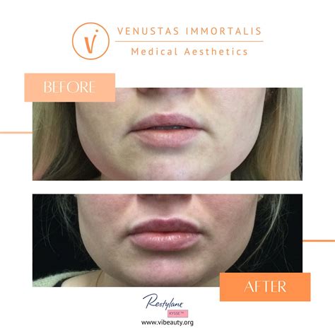 Dermal Fillers For Volume And Contouring JuvÉderm® Restylane