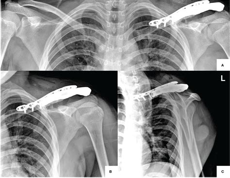 Frontiers Innovative Method With Two Stage Surgery For Ewing Sarcoma