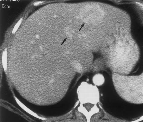 Hepatic Adenomas Imaging And Pathologic Findings Radiographics