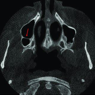 Axial View Of Cone Beam Computed Tomography Showing A Complete Septum