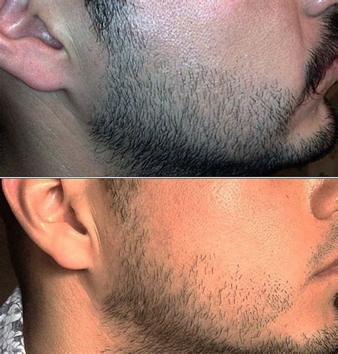 Minoxidil Before And After Beard Result Minoxidil Beard Journey