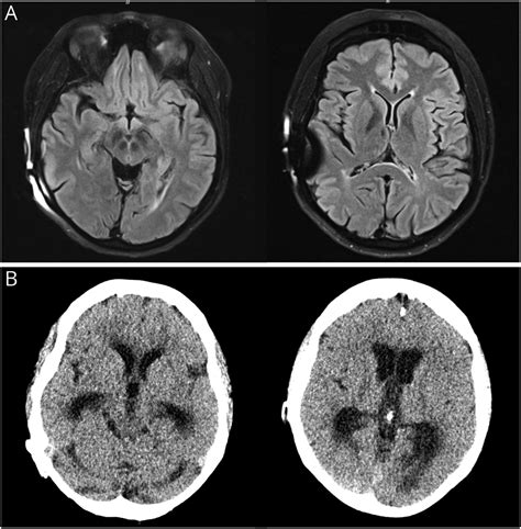 Parinaud Syndrom