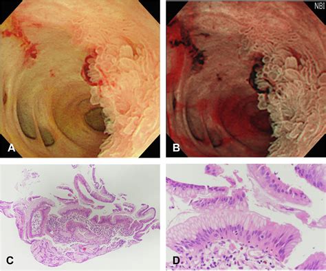 Detection And Endoscopic Classification Of Intraductal Neoplasms Of The