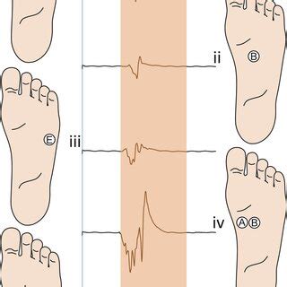 Emg Traces Of A Representative Subject On Five Different Stimulation