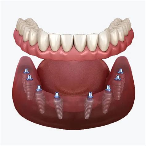 Impianti Dentali In Albania Sanmarco Dental