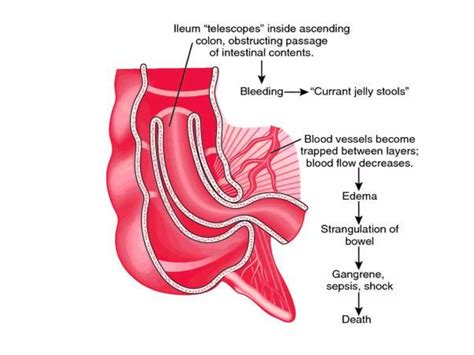 Intussusception Ppt