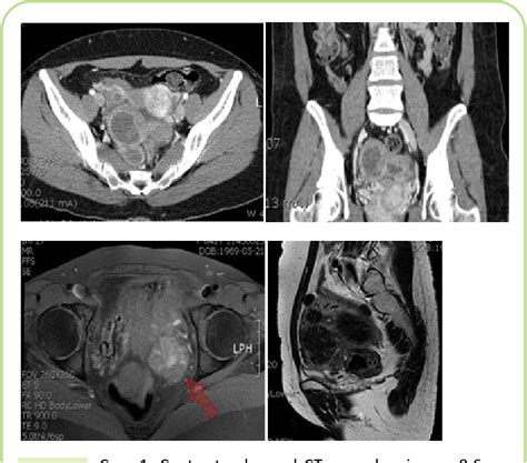 Figure 1 from Extrauterine Adenomyoma Invading the Sigmoid Mesocolon in the Pelvic Cavity ...