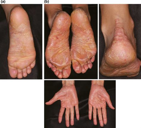 Palmoplantar Keratodermas Causes Symptoms Diagnosis Treatment