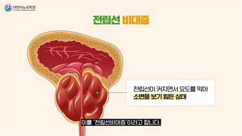 콕건강 전립선비대증 늙으면 생기는 병 그냥 두면 합병증 생겨요 아시아경제