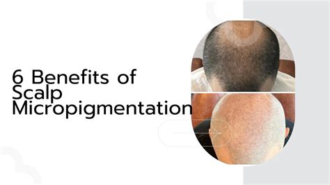 Ppt 6 Benefits Of Scalp Micropigmentation Powerpoint Presentation