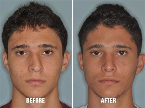 Fixing A Crooked Nose With Rhinoplasty Miami FL