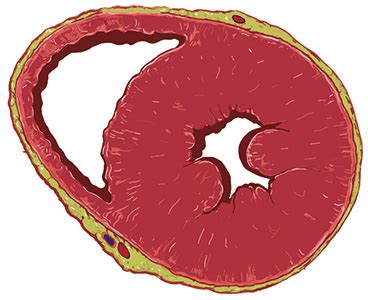 What is cardiac hypertrophy? | CardioSecur