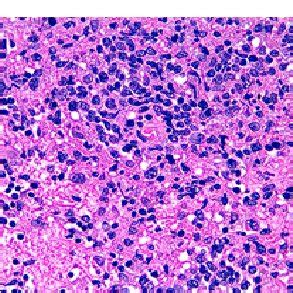 H&E. The brain parenchyma is involved by a lymphoid infiltrate ...