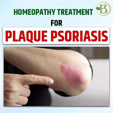 Achieving A Permanent Solution For Psoriasis Naturally Effective Treatments For Facial And