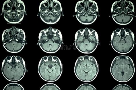 MRI scan of the brain stock image. Image of test, magnetic - 116848107