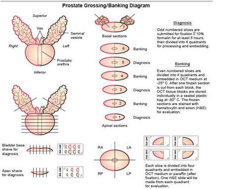 Prostate Cutting Device