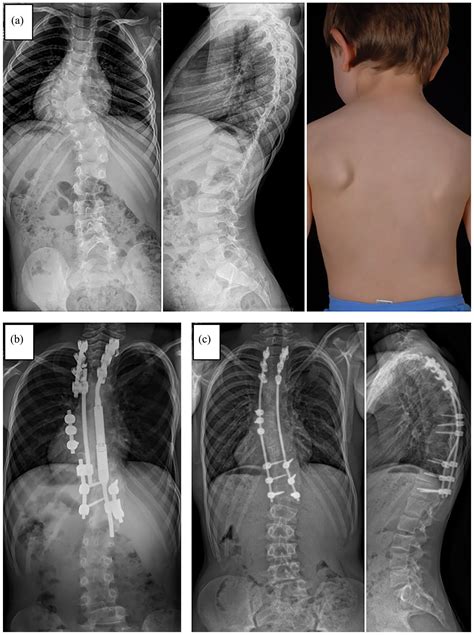 Diagnostic And Therapeutic Strategies In Early Onset Scoliosis A