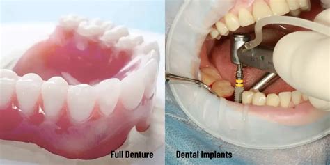 Top 5 Benefits Of Dental Implants Over Dentures Must Read Now