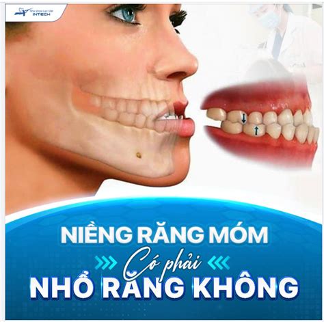 NIỀNG RĂNG MÓM CÓ PHẢI NHỔ RĂNG KHÔNG