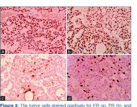 Figure 2 From Endocrine Mucin Producing Sweat Gland Carcinoma Of The