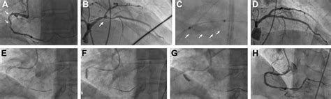 Intracoronary Lithoplasty In Percutaneous Treatment Of Challenging